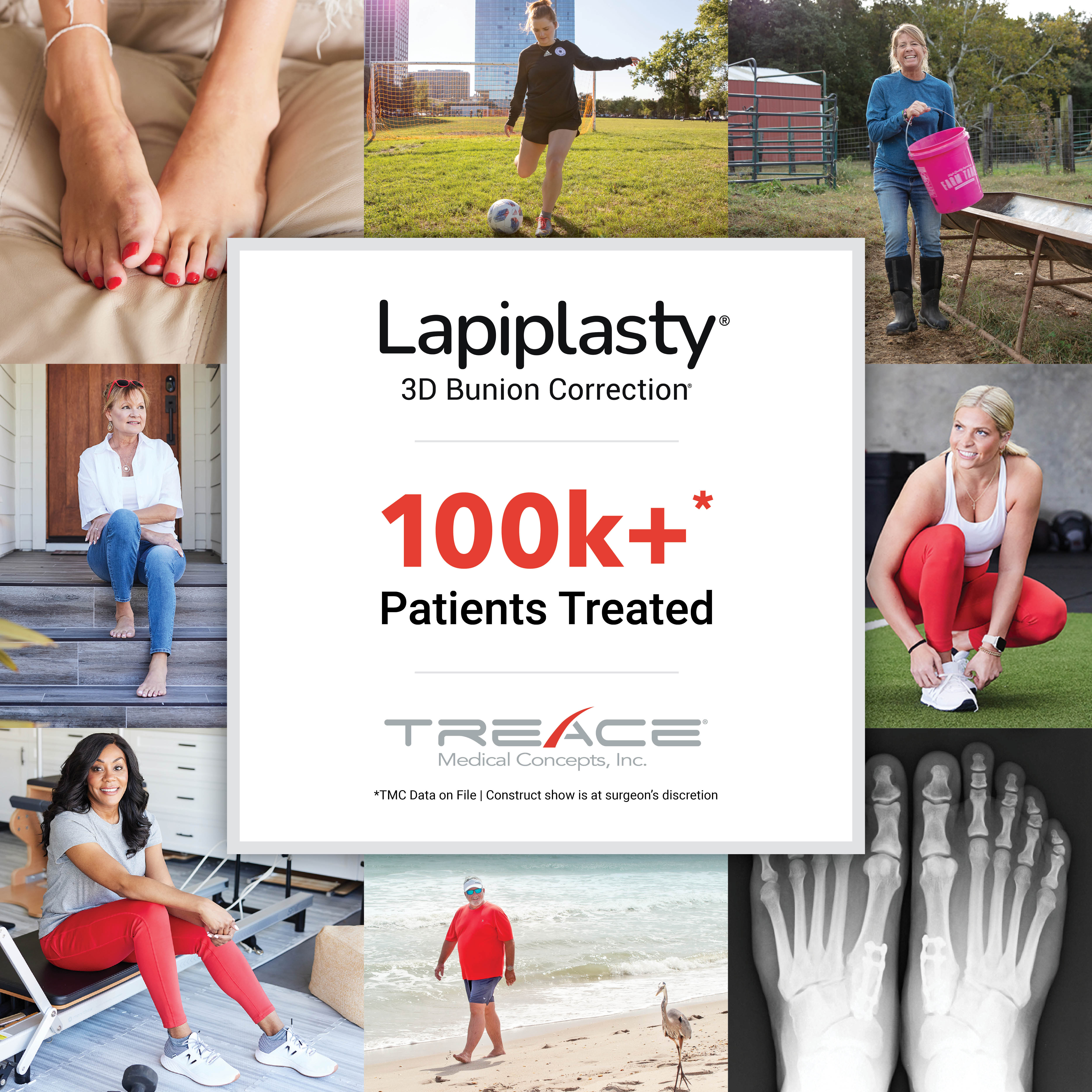 Treace 100K+ Lapiplasty Patients